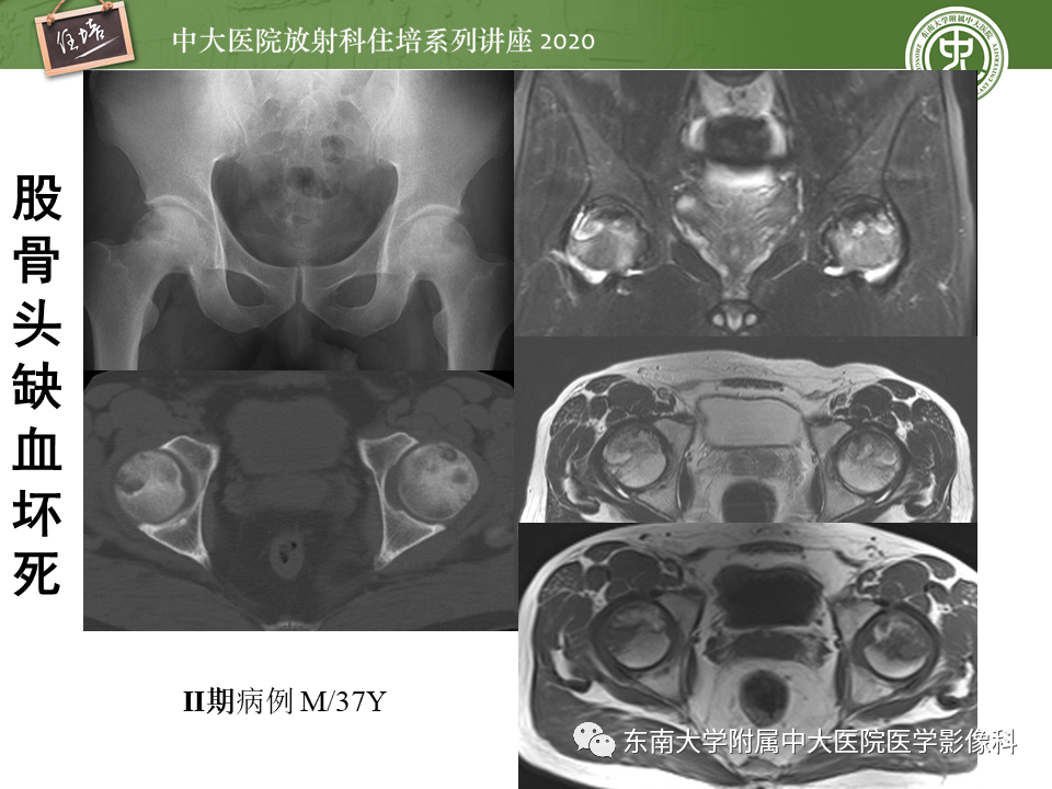 影像PPT - 【PPT】骨缺血坏死性病变的影像学特征-20