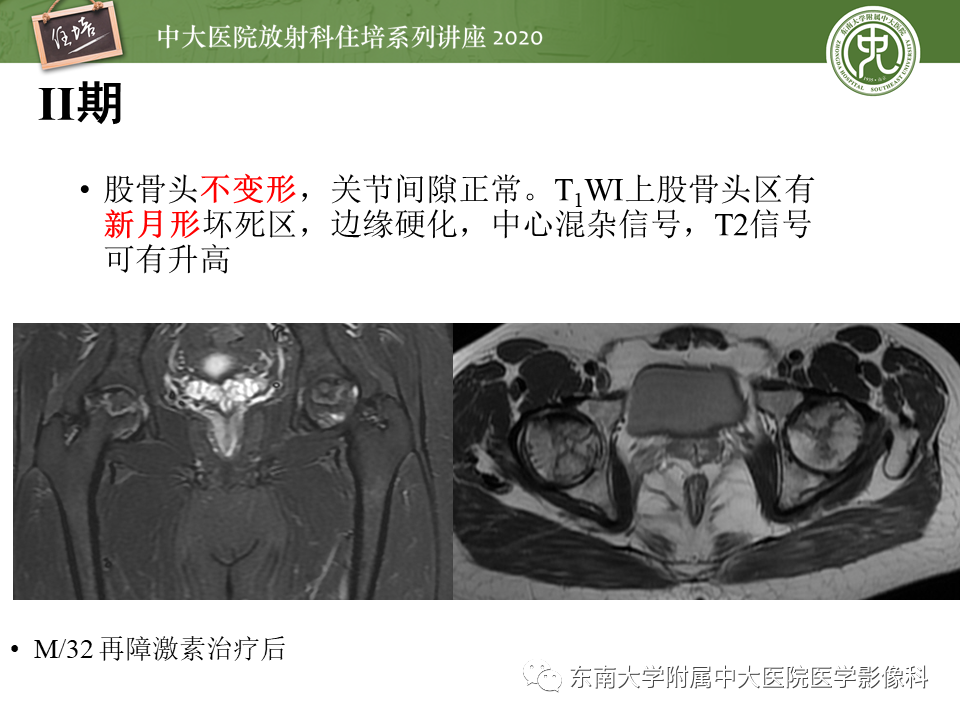 影像PPT - 【PPT】骨缺血坏死性病变的影像学特征-19