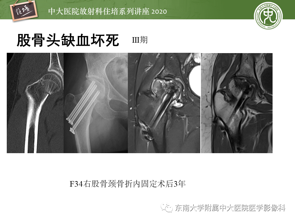影像PPT - 【PPT】骨缺血坏死性病变的影像学特征-22