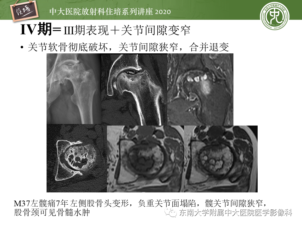 影像PPT - 【PPT】骨缺血坏死性病变的影像学特征-23