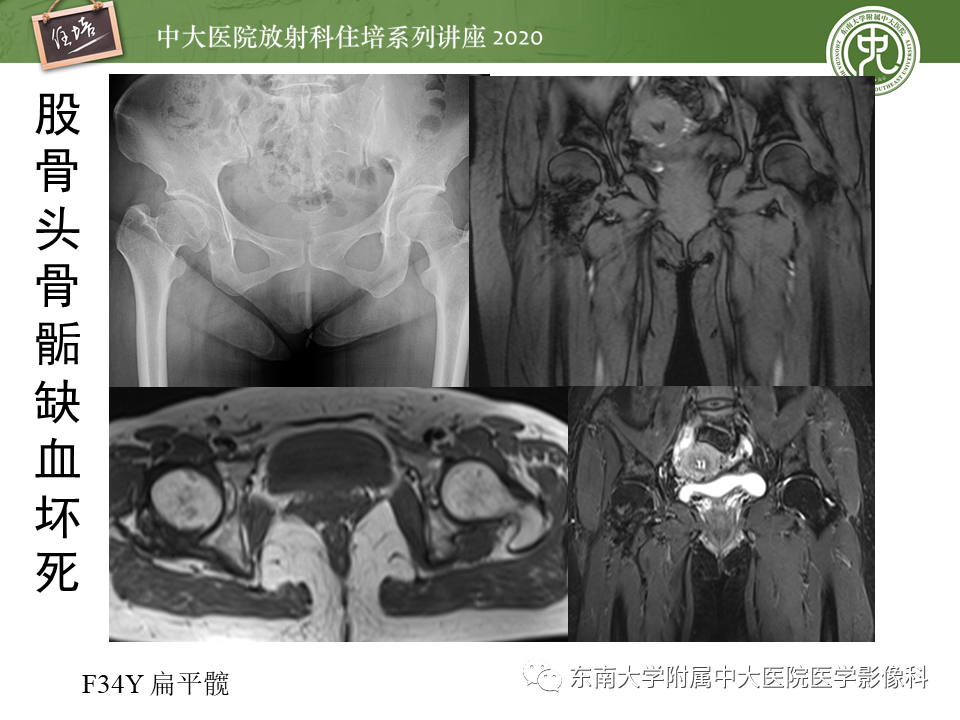 影像PPT - 【PPT】骨缺血坏死性病变的影像学特征-29