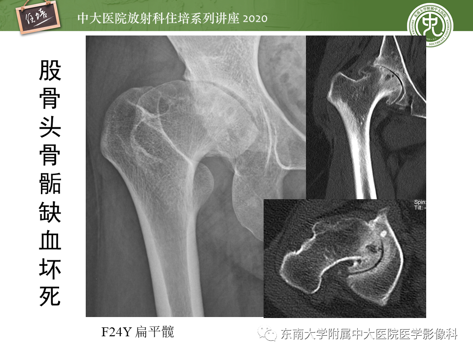 影像PPT - 【PPT】骨缺血坏死性病变的影像学特征-30