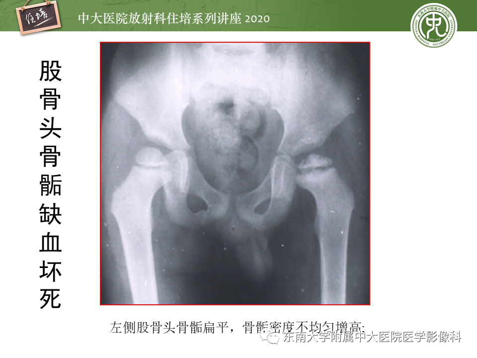 影像PPT - 【PPT】骨缺血坏死性病变的影像学特征-28