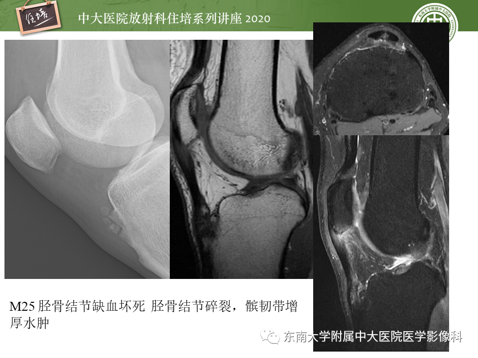 影像PPT - 【PPT】骨缺血坏死性病变的影像学特征-33