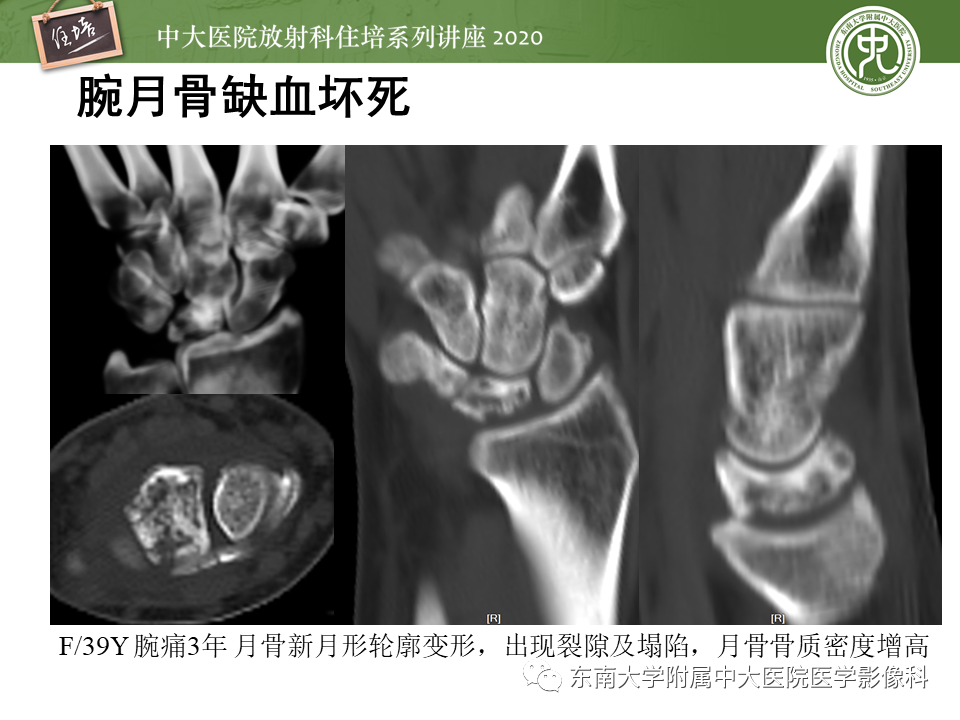 影像PPT - 【PPT】骨缺血坏死性病变的影像学特征-36