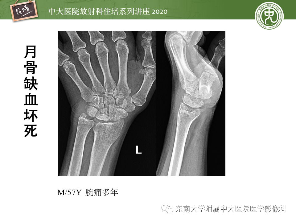 影像PPT - 【PPT】骨缺血坏死性病变的影像学特征-37