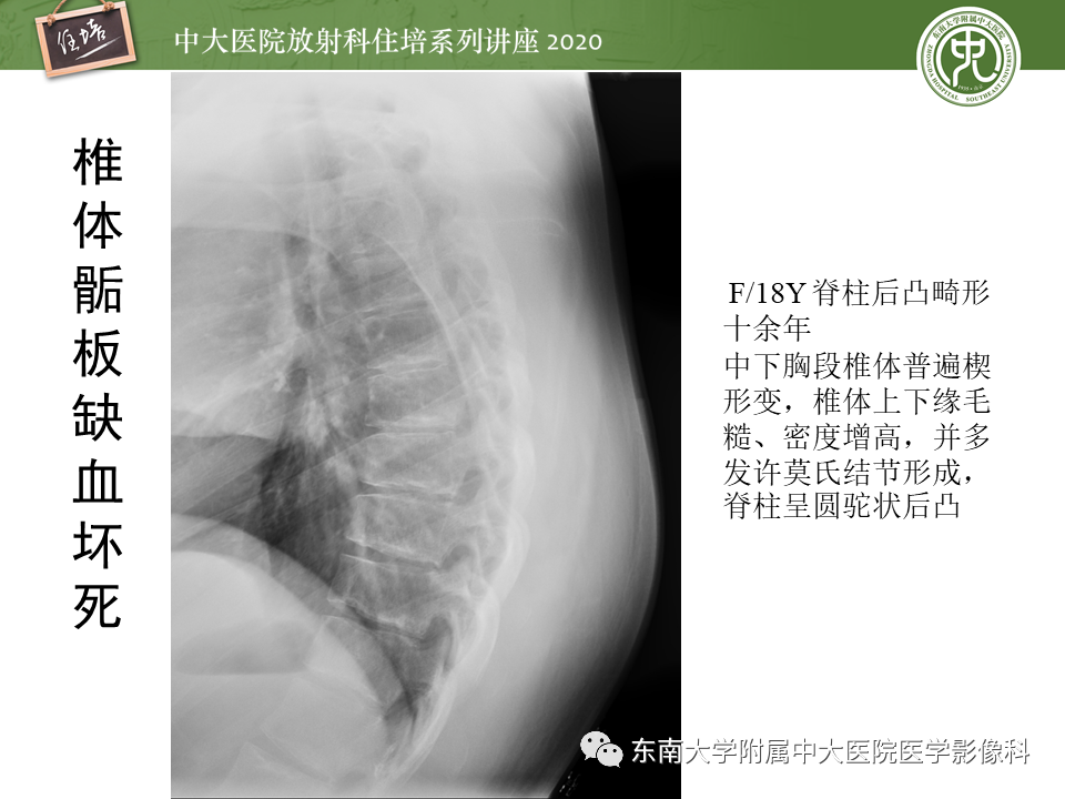 影像PPT - 【PPT】骨缺血坏死性病变的影像学特征-40