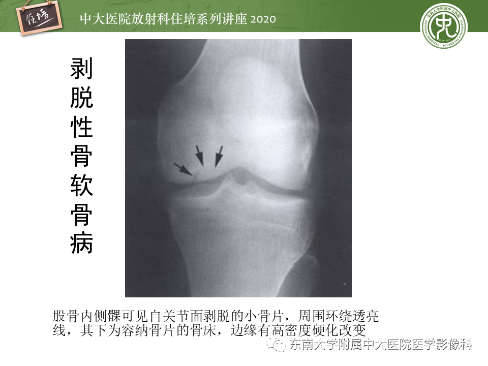 影像PPT - 【PPT】骨缺血坏死性病变的影像学特征-43