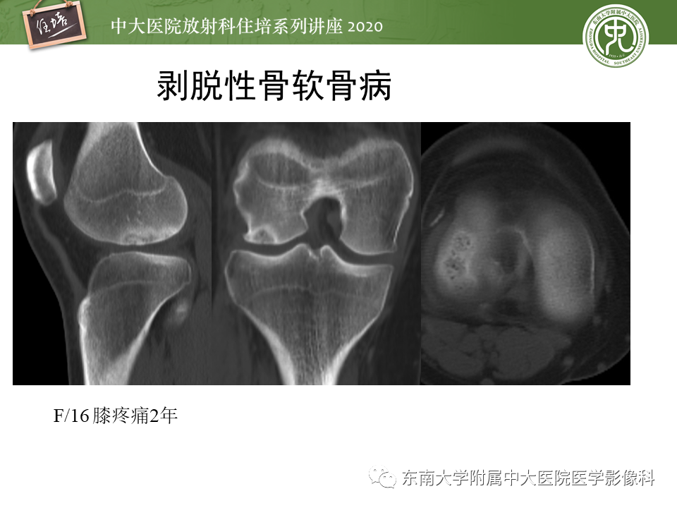 影像PPT - 【PPT】骨缺血坏死性病变的影像学特征-44