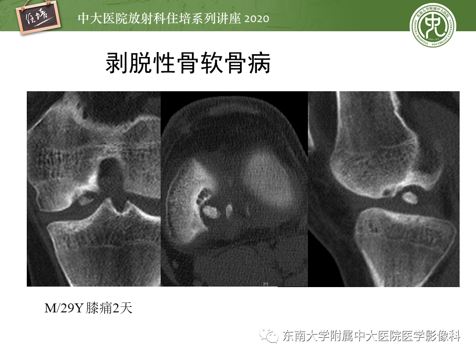 影像PPT - 【PPT】骨缺血坏死性病变的影像学特征-45