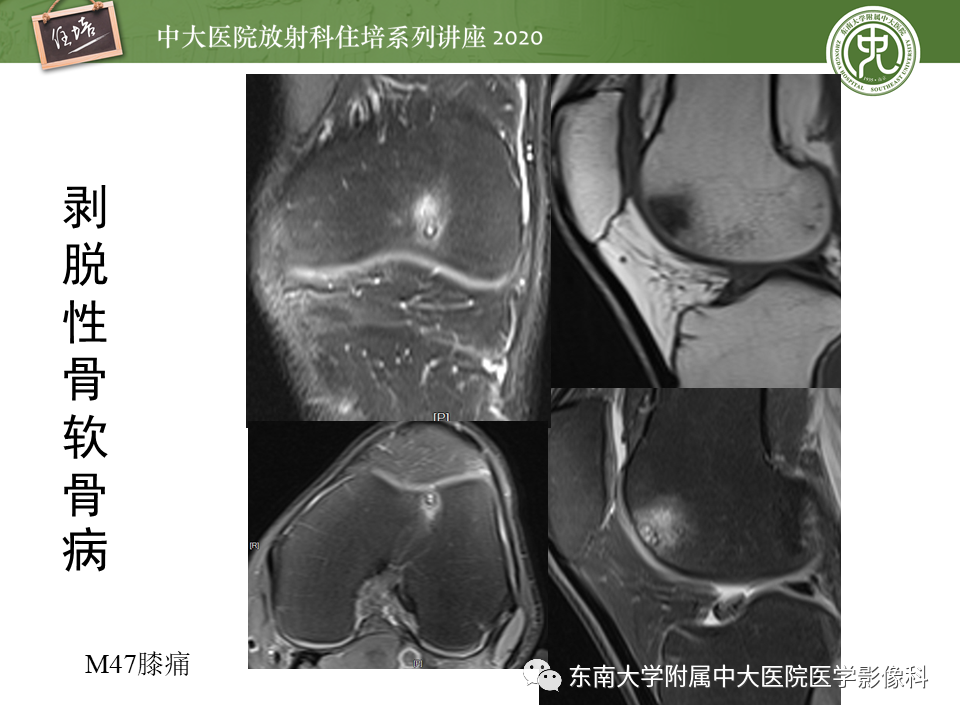 影像PPT - 【PPT】骨缺血坏死性病变的影像学特征-46