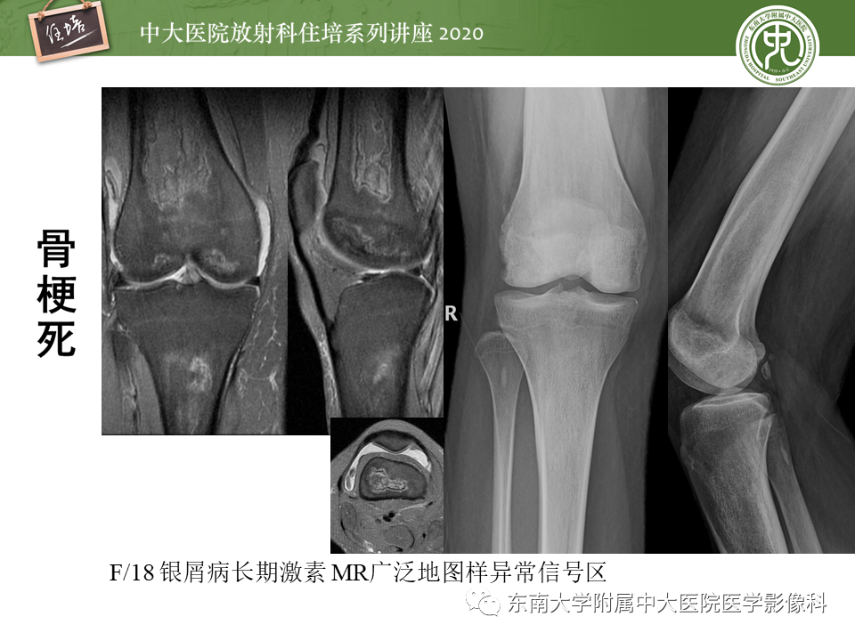 影像PPT - 【PPT】骨缺血坏死性病变的影像学特征-52