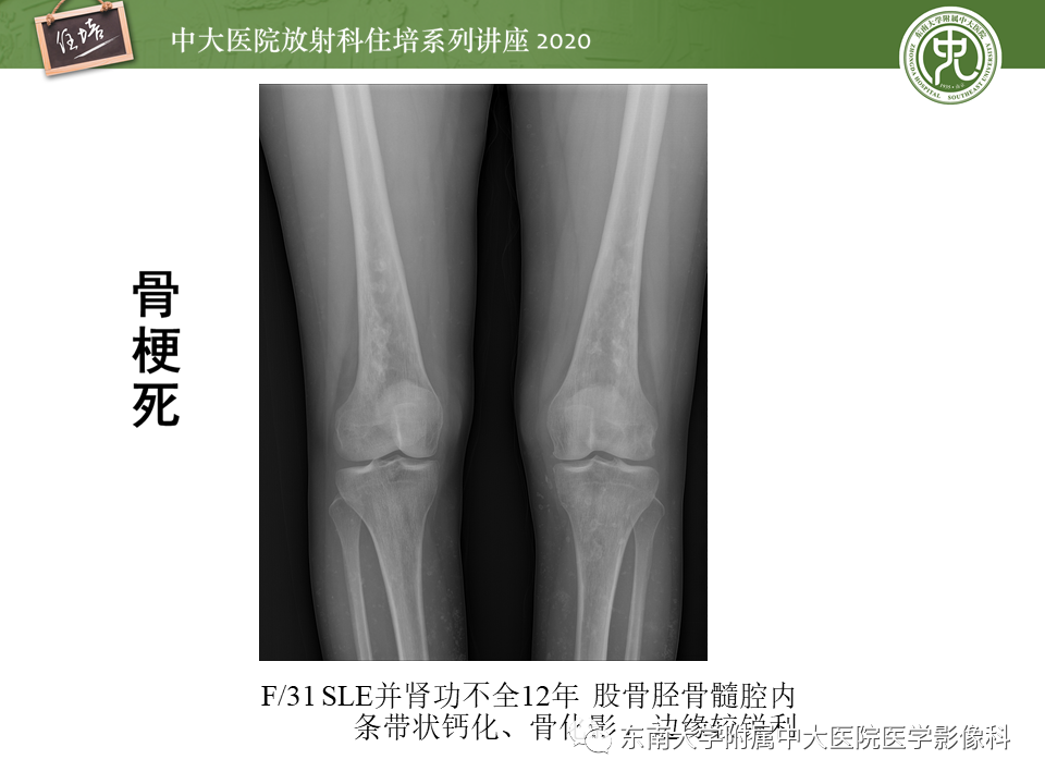 影像PPT - 【PPT】骨缺血坏死性病变的影像学特征-50