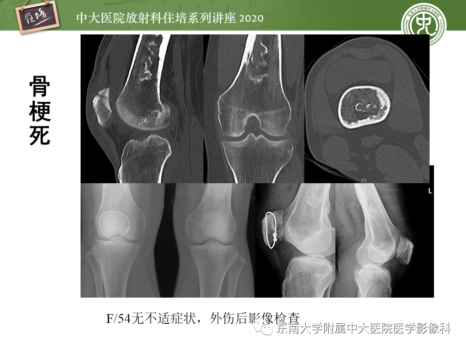 影像PPT - 【PPT】骨缺血坏死性病变的影像学特征-51