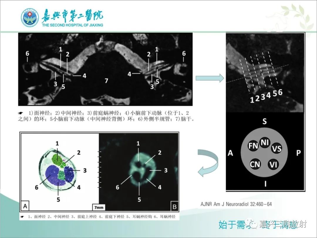 影像PPT - 【PPT】内耳MR成像解剖及观察-3