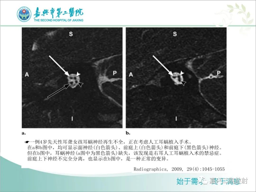 影像PPT - 【PPT】内耳MR成像解剖及观察-4