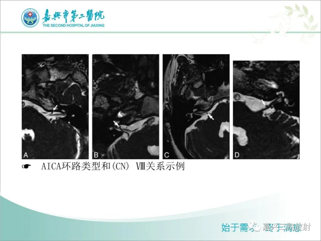 影像PPT - 【PPT】内耳MR成像解剖及观察-8