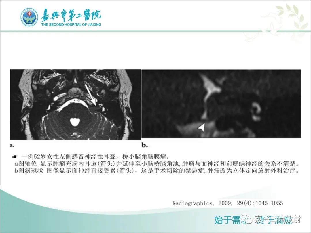 影像PPT - 【PPT】内耳MR成像解剖及观察-10