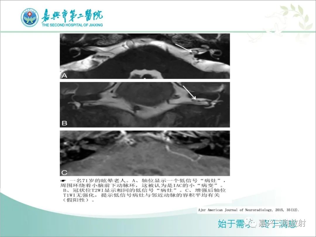 影像PPT - 【PPT】内耳MR成像解剖及观察-11