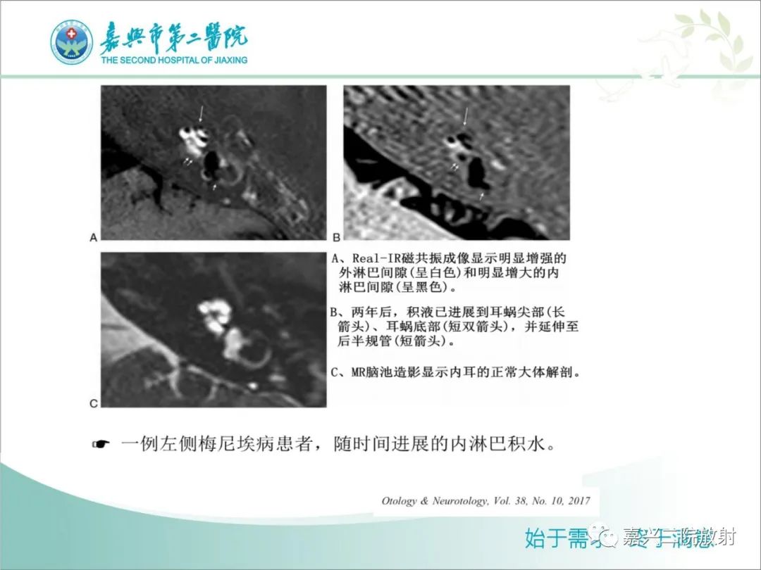 影像PPT - 【PPT】内耳MR成像解剖及观察-15