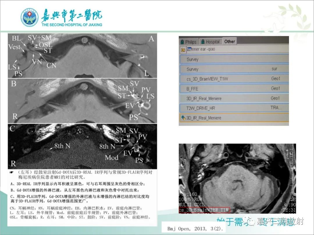 影像PPT - 【PPT】内耳MR成像解剖及观察-17