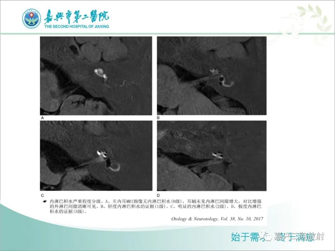 影像PPT - 【PPT】内耳MR成像解剖及观察-16
