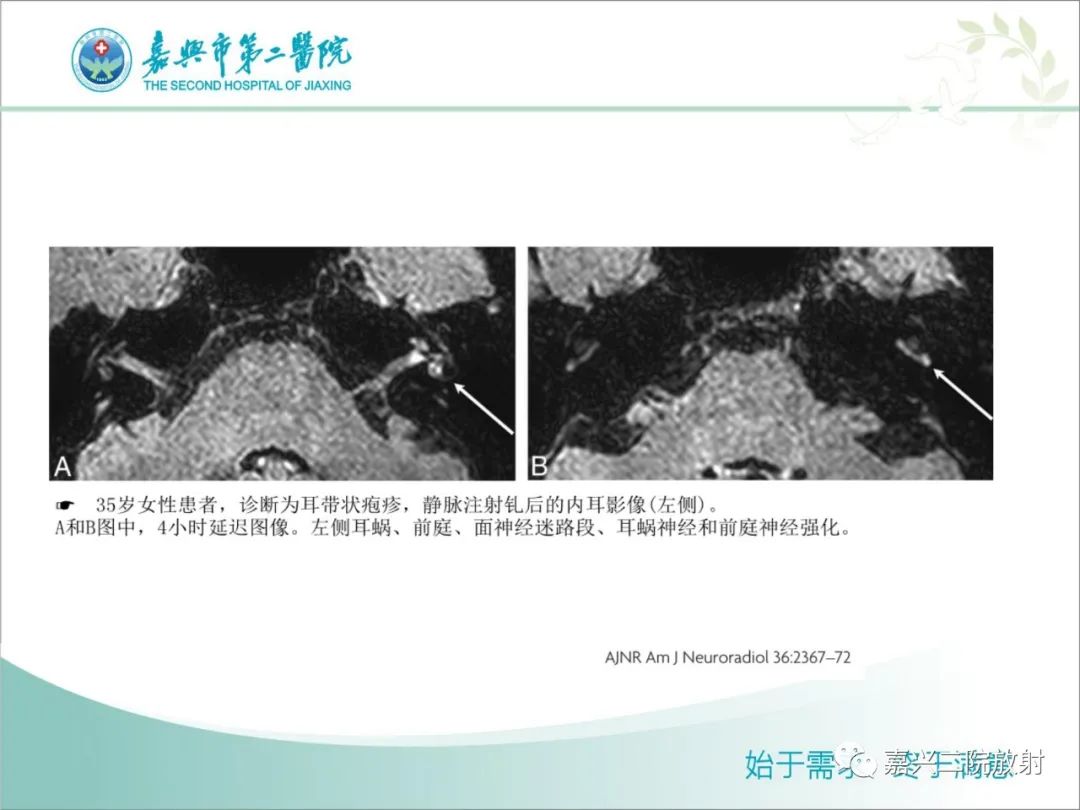影像PPT - 【PPT】内耳MR成像解剖及观察-19