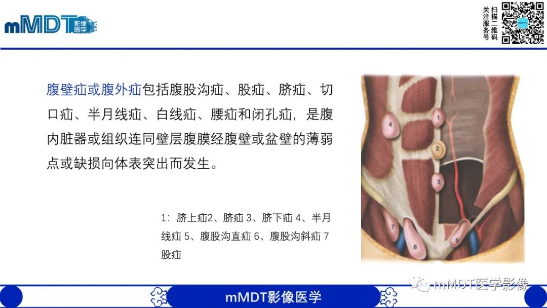 影像PPT - 【PPT】常见腹外疝的影像诊断-2 影像PPT - 【PPT】常见腹外疝的影像诊断-2