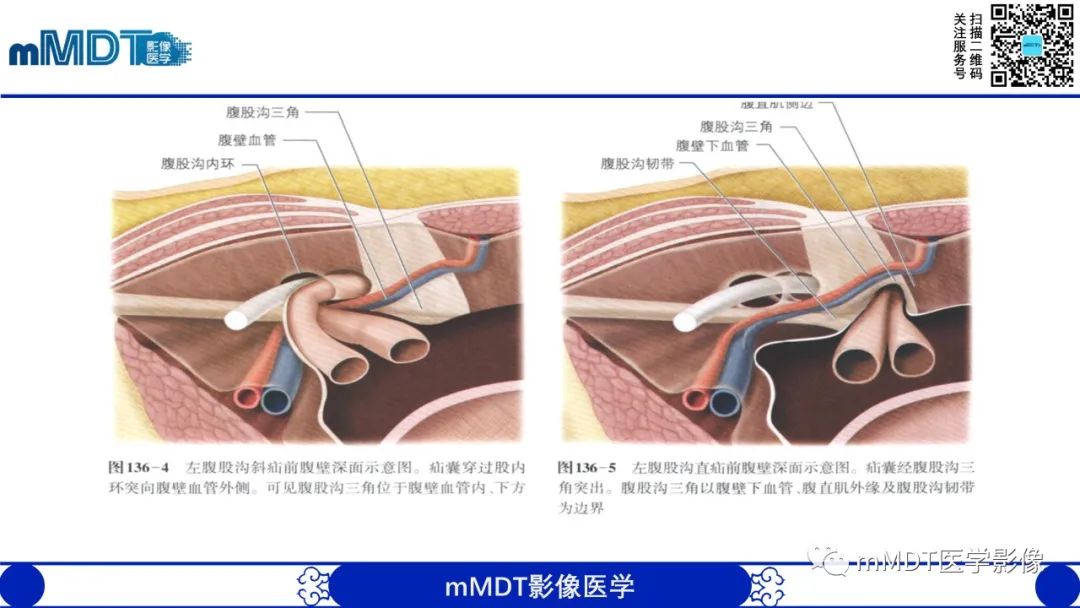 影像PPT - 【PPT】常见腹外疝的影像诊断-5 影像PPT - 【PPT】常见腹外疝的影像诊断-5