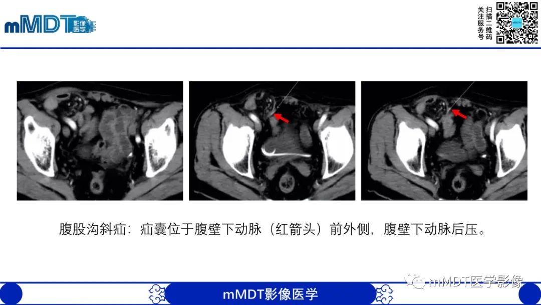 影像PPT - 【PPT】常见腹外疝的影像诊断-6 影像PPT - 【PPT】常见腹外疝的影像诊断-6
