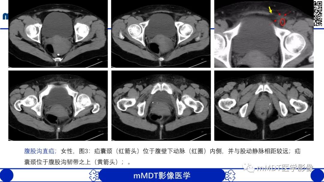 影像PPT - 【PPT】常见腹外疝的影像诊断-9 影像PPT - 【PPT】常见腹外疝的影像诊断-9
