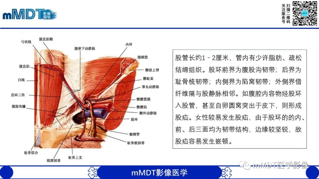 影像PPT - 【PPT】常见腹外疝的影像诊断-10 影像PPT - 【PPT】常见腹外疝的影像诊断-10