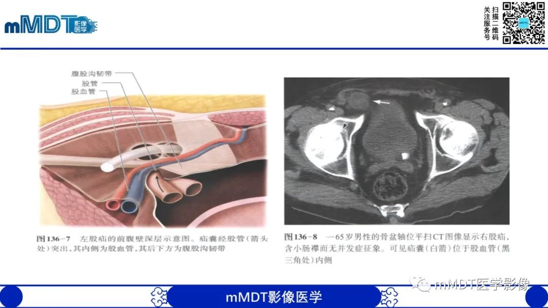 影像PPT - 【PPT】常见腹外疝的影像诊断-11 影像PPT - 【PPT】常见腹外疝的影像诊断-11