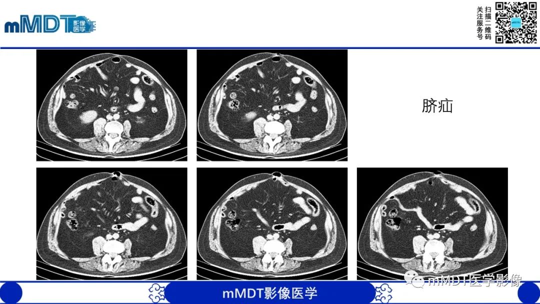 影像PPT - 【PPT】常见腹外疝的影像诊断-17 影像PPT - 【PPT】常见腹外疝的影像诊断-17