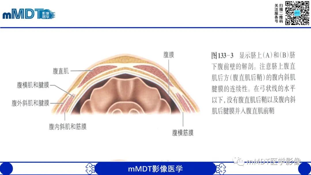 影像PPT - 【PPT】常见腹外疝的影像诊断-18 影像PPT - 【PPT】常见腹外疝的影像诊断-18