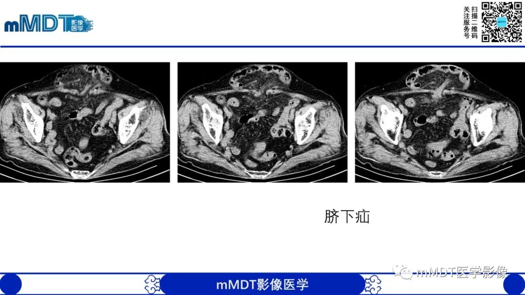 影像PPT - 【PPT】常见腹外疝的影像诊断-19 影像PPT - 【PPT】常见腹外疝的影像诊断-19