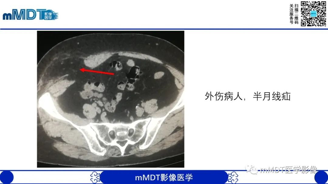 影像PPT - 【PPT】常见腹外疝的影像诊断-22 影像PPT - 【PPT】常见腹外疝的影像诊断-22