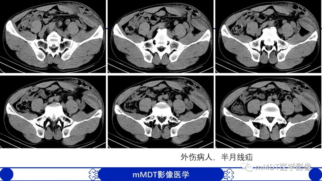 影像PPT - 【PPT】常见腹外疝的影像诊断-21 影像PPT - 【PPT】常见腹外疝的影像诊断-21