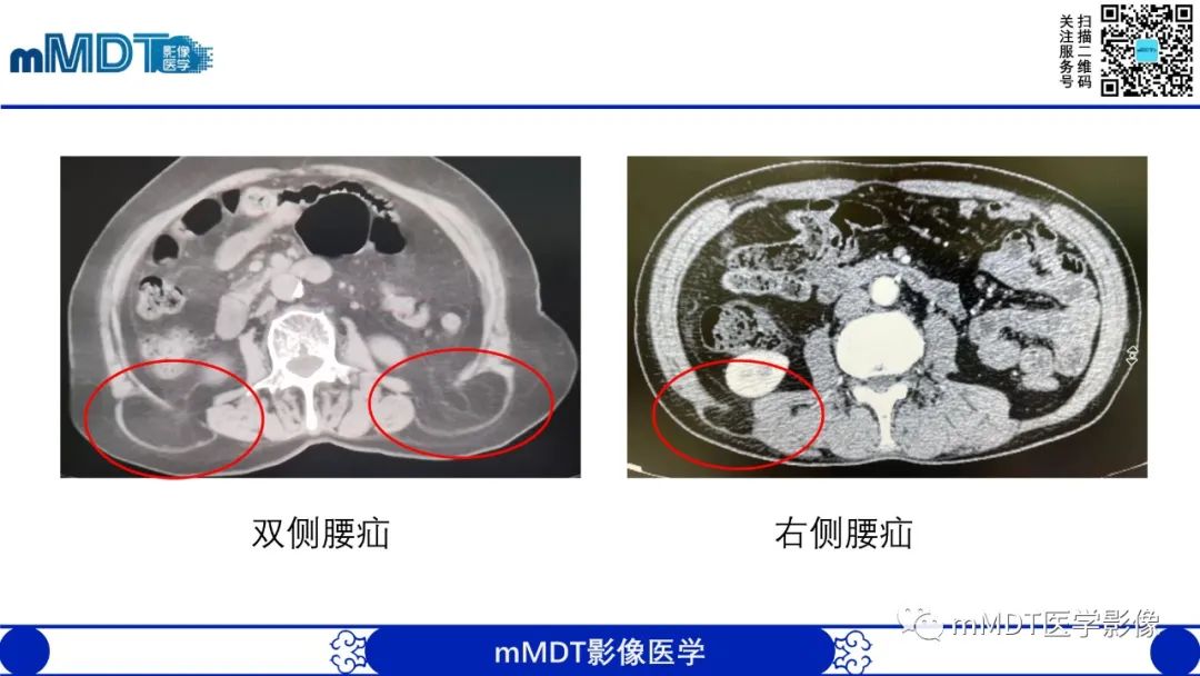影像PPT - 【PPT】常见腹外疝的影像诊断-27 影像PPT - 【PPT】常见腹外疝的影像诊断-27