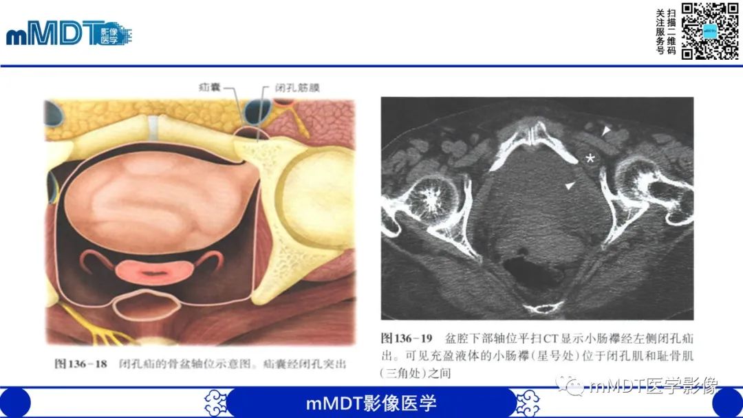 影像PPT - 【PPT】常见腹外疝的影像诊断-29 影像PPT - 【PPT】常见腹外疝的影像诊断-29