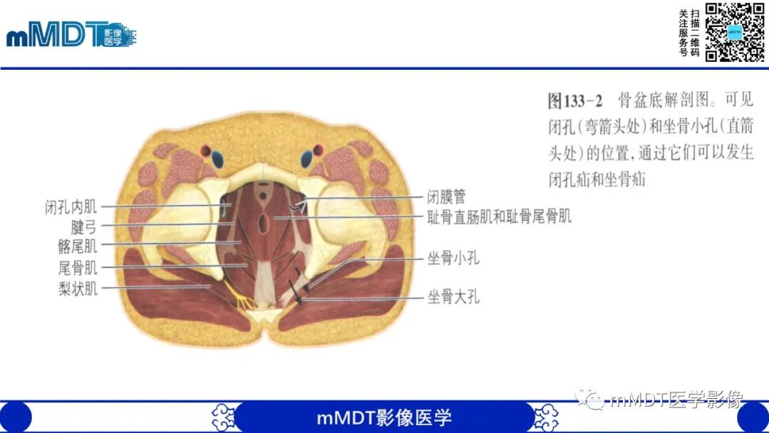 影像PPT - 【PPT】常见腹外疝的影像诊断-28 影像PPT - 【PPT】常见腹外疝的影像诊断-28