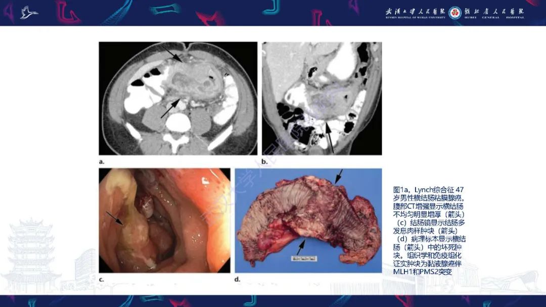 影像PPT - 【PPT】遗传性胃肠肿瘤综合征：影像学在筛查、诊断和治疗中的作用-7