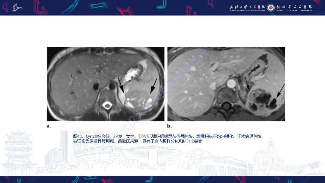 影像PPT - 【PPT】遗传性胃肠肿瘤综合征：影像学在筛查、诊断和治疗中的作用-10