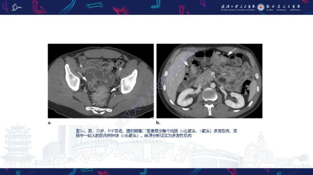 影像PPT - 【PPT】遗传性胃肠肿瘤综合征：影像学在筛查、诊断和治疗中的作用-15