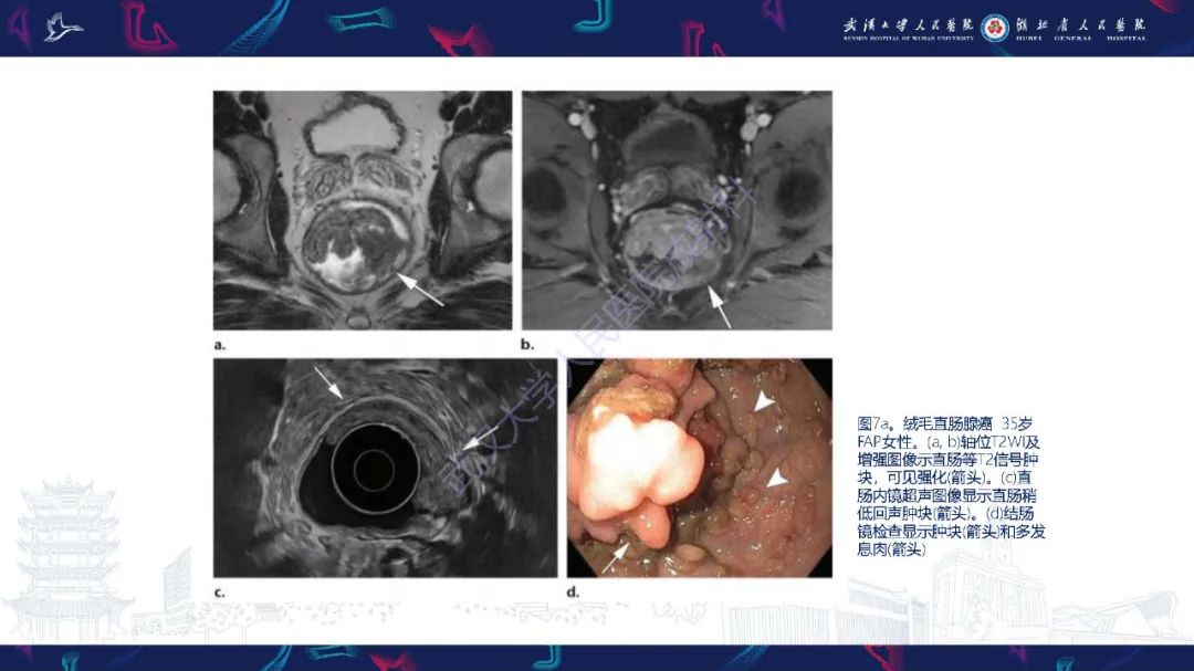 影像PPT - 【PPT】遗传性胃肠肿瘤综合征：影像学在筛查、诊断和治疗中的作用-16