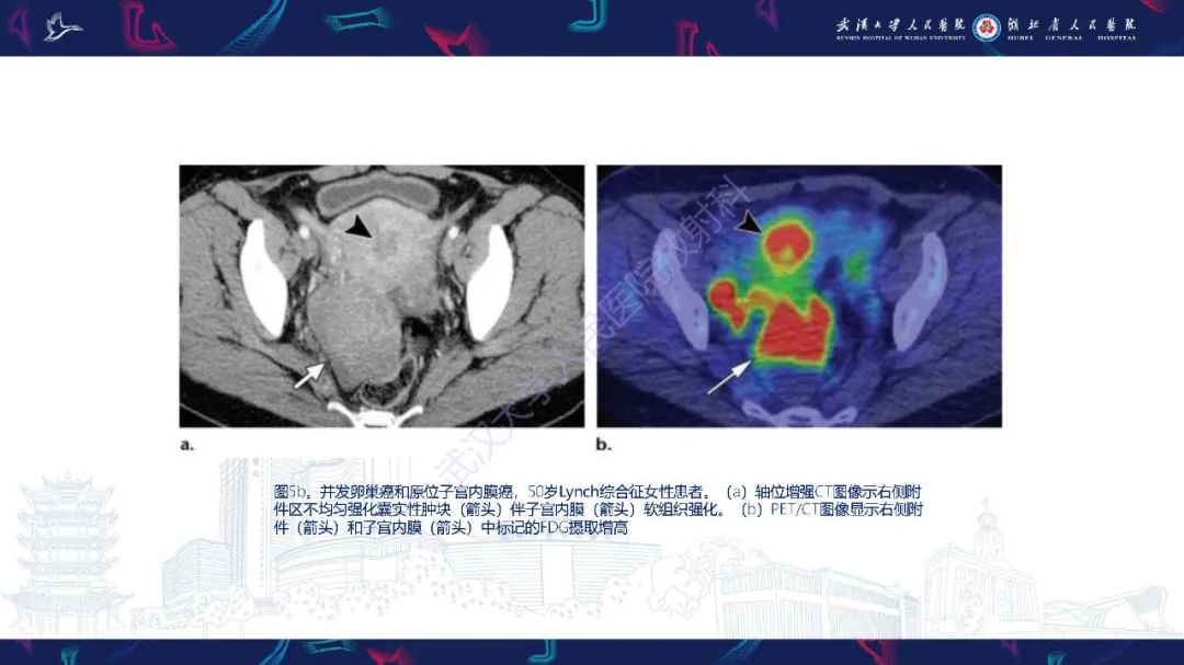 影像PPT - 【PPT】遗传性胃肠肿瘤综合征：影像学在筛查、诊断和治疗中的作用-11