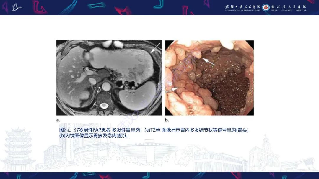 影像PPT - 【PPT】遗传性胃肠肿瘤综合征：影像学在筛查、诊断和治疗中的作用-17