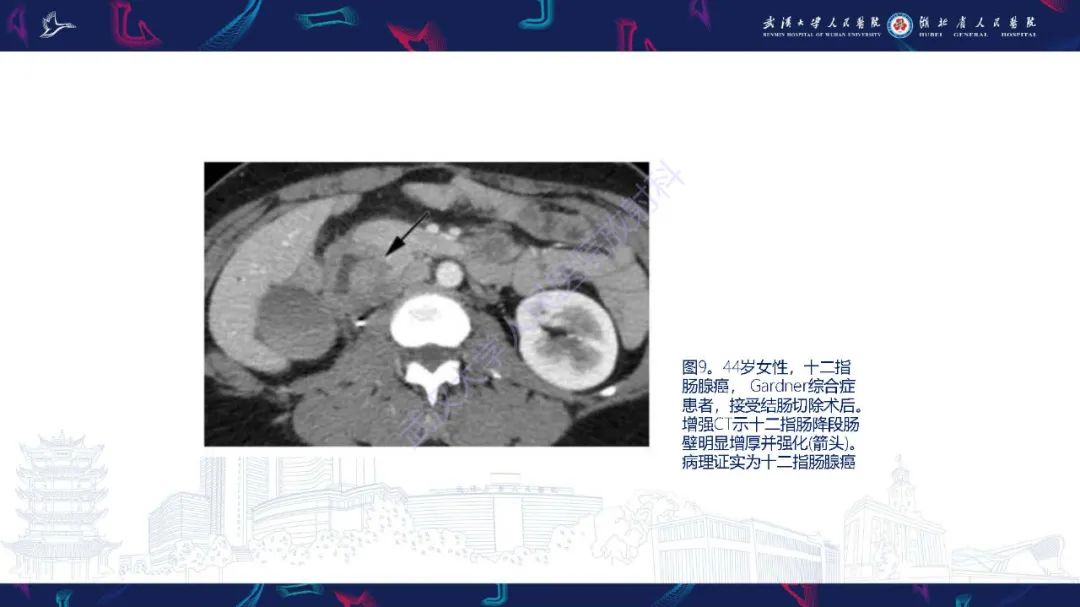 影像PPT - 【PPT】遗传性胃肠肿瘤综合征：影像学在筛查、诊断和治疗中的作用-18