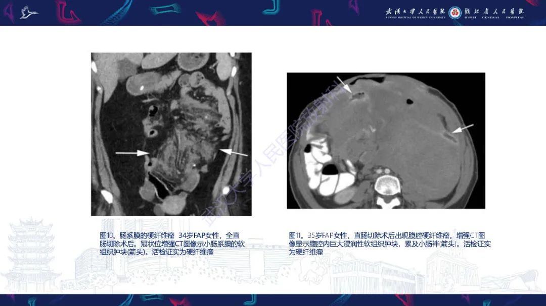 影像PPT - 【PPT】遗传性胃肠肿瘤综合征：影像学在筛查、诊断和治疗中的作用-20