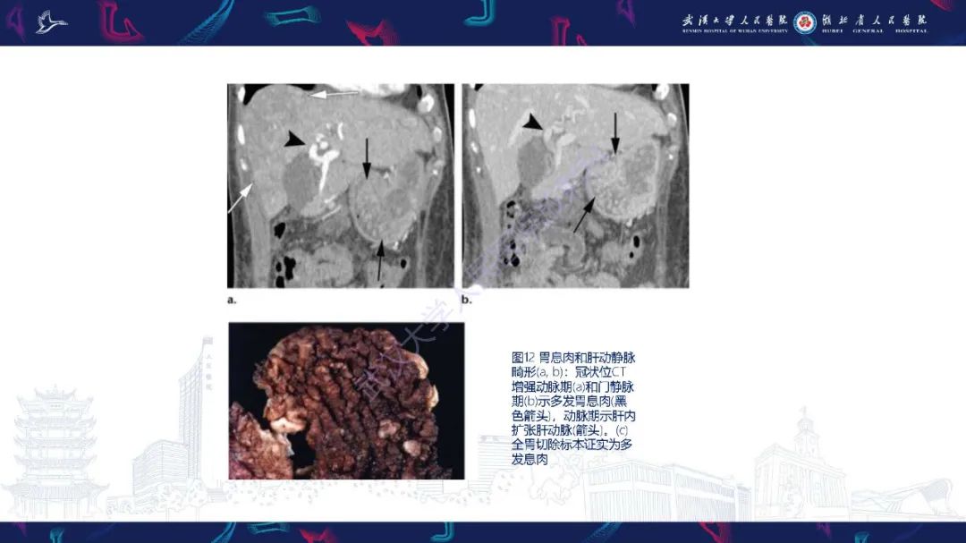 影像PPT - 【PPT】遗传性胃肠肿瘤综合征：影像学在筛查、诊断和治疗中的作用-23
